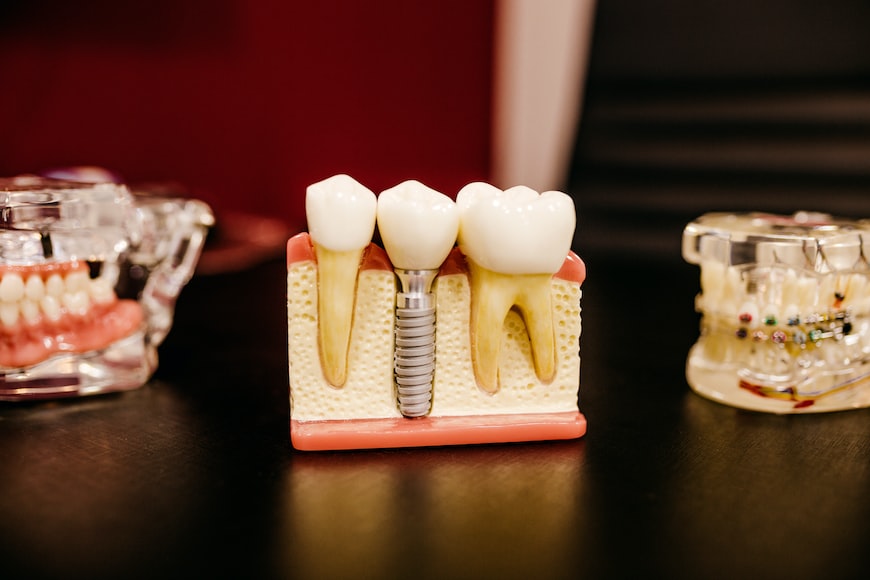 How Dental Implants Can Change Your Life
